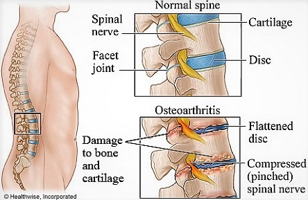 arthrose-bas-du-dos